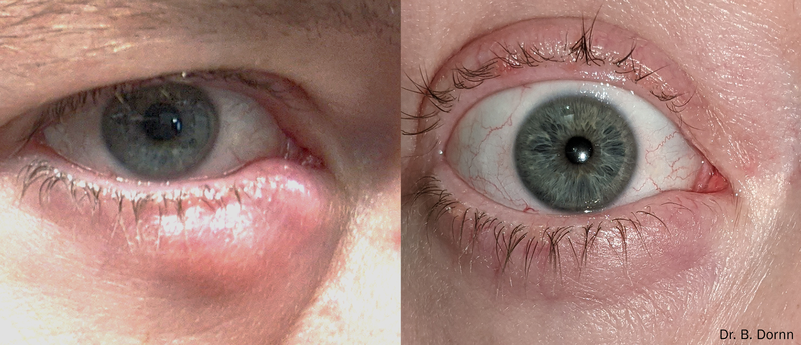  Forma-I Before and After