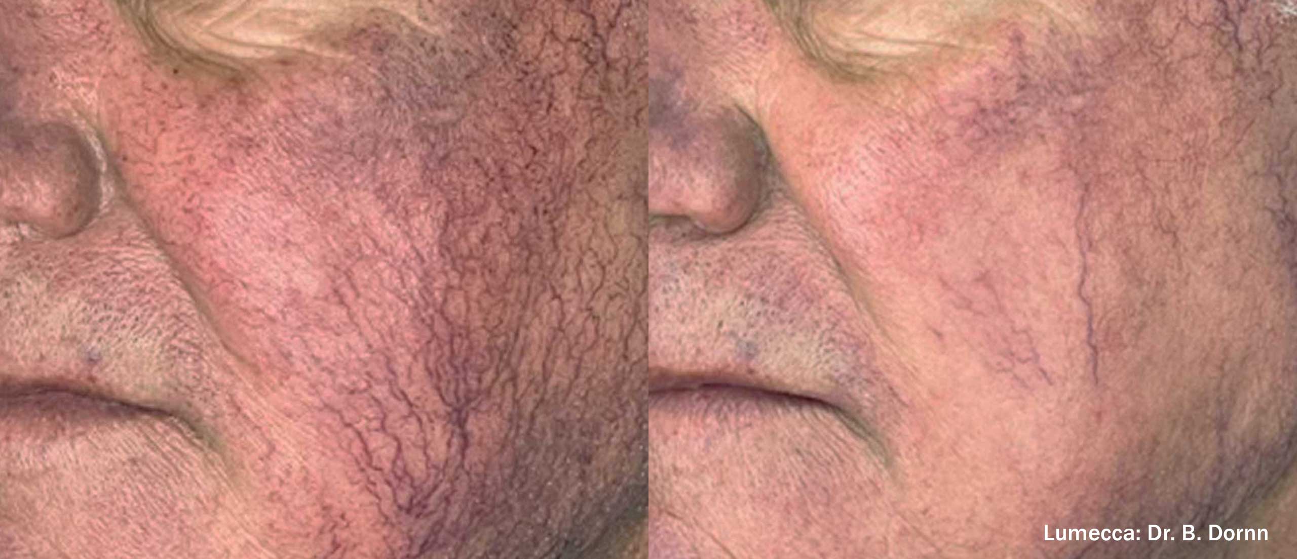 Lumecca-I Before and After