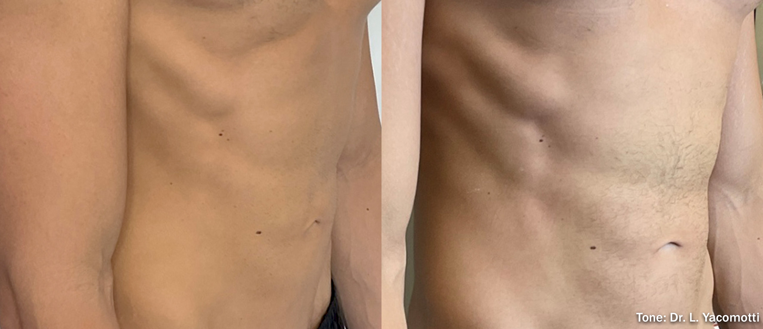  Tone on Abdomen