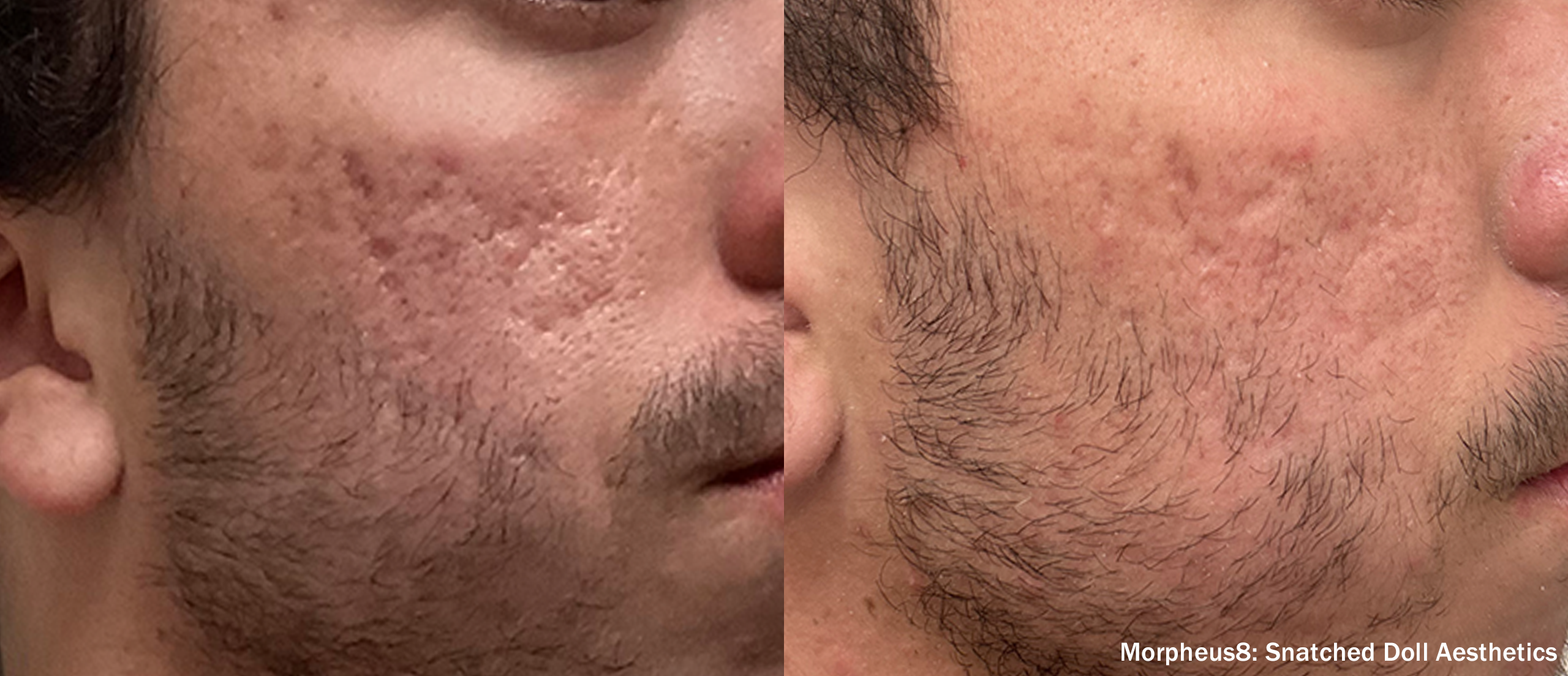  Morpheus8 Burst for Acne Scars
